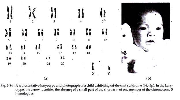 Karyotype and Photograph of a Child