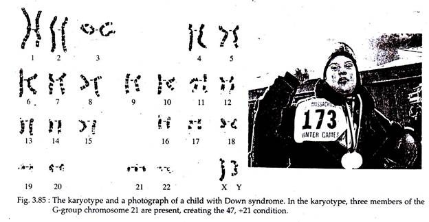 Karyotype and a Photograph of a Child