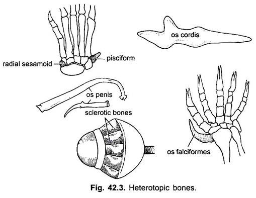 Heterotopic Bones