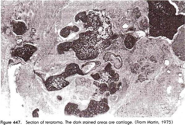 Section of Teratoma