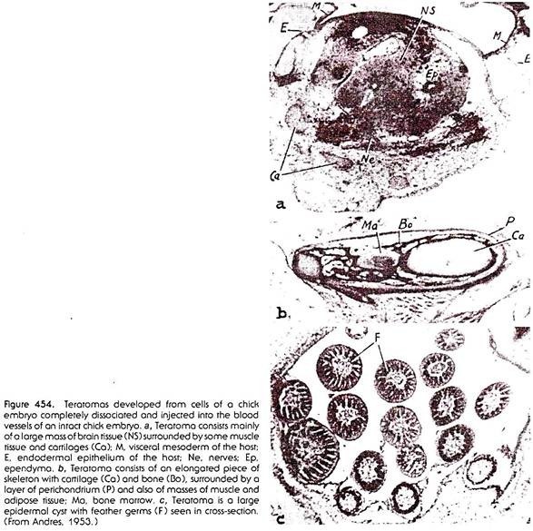 Teratomas